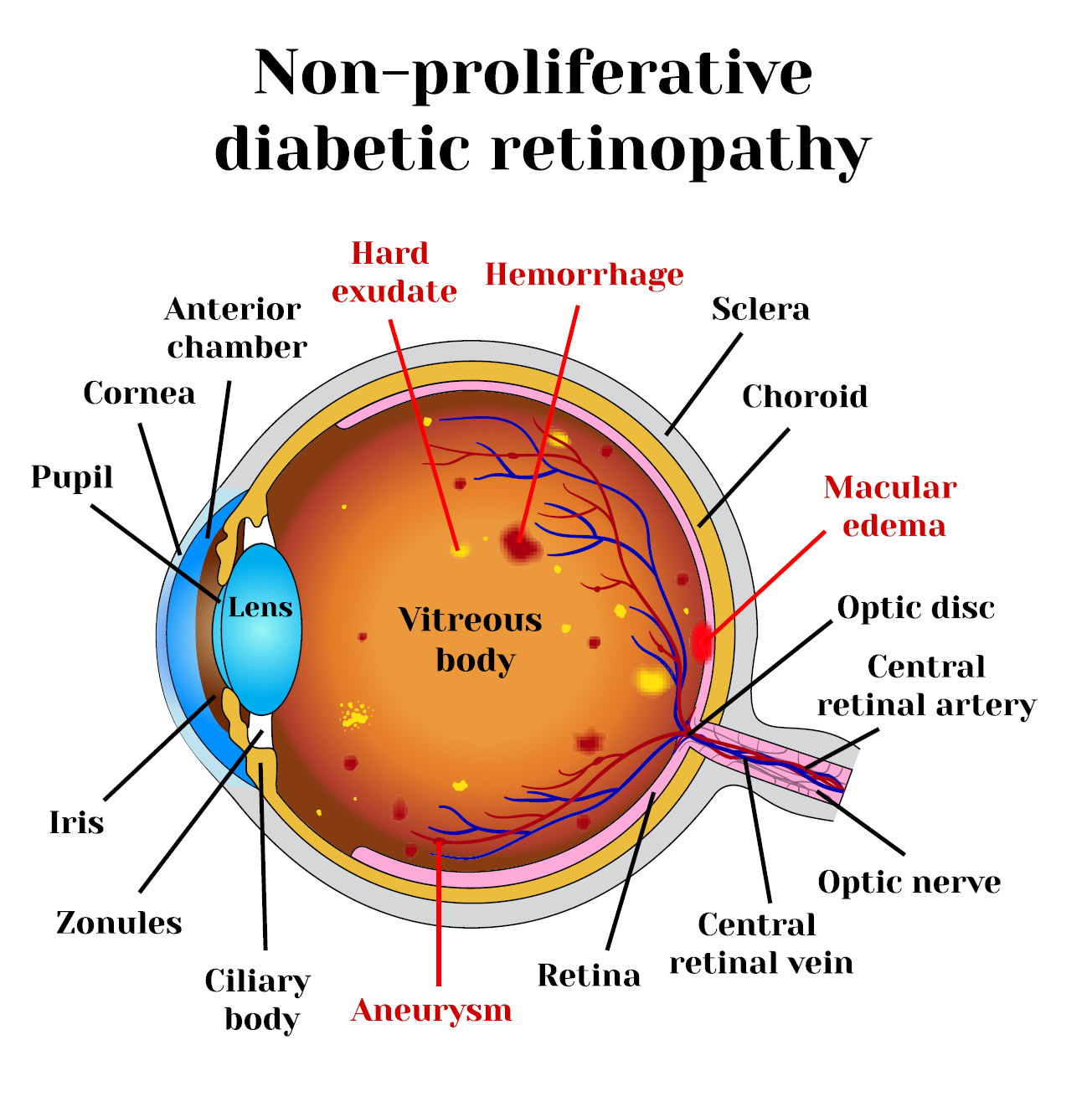 Diabetes & Vision Problems