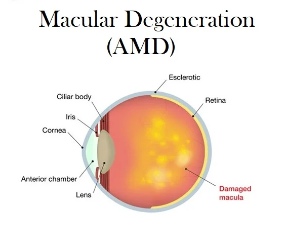 Macular Degeneration of the Eye / Age Related Macular Degeneration