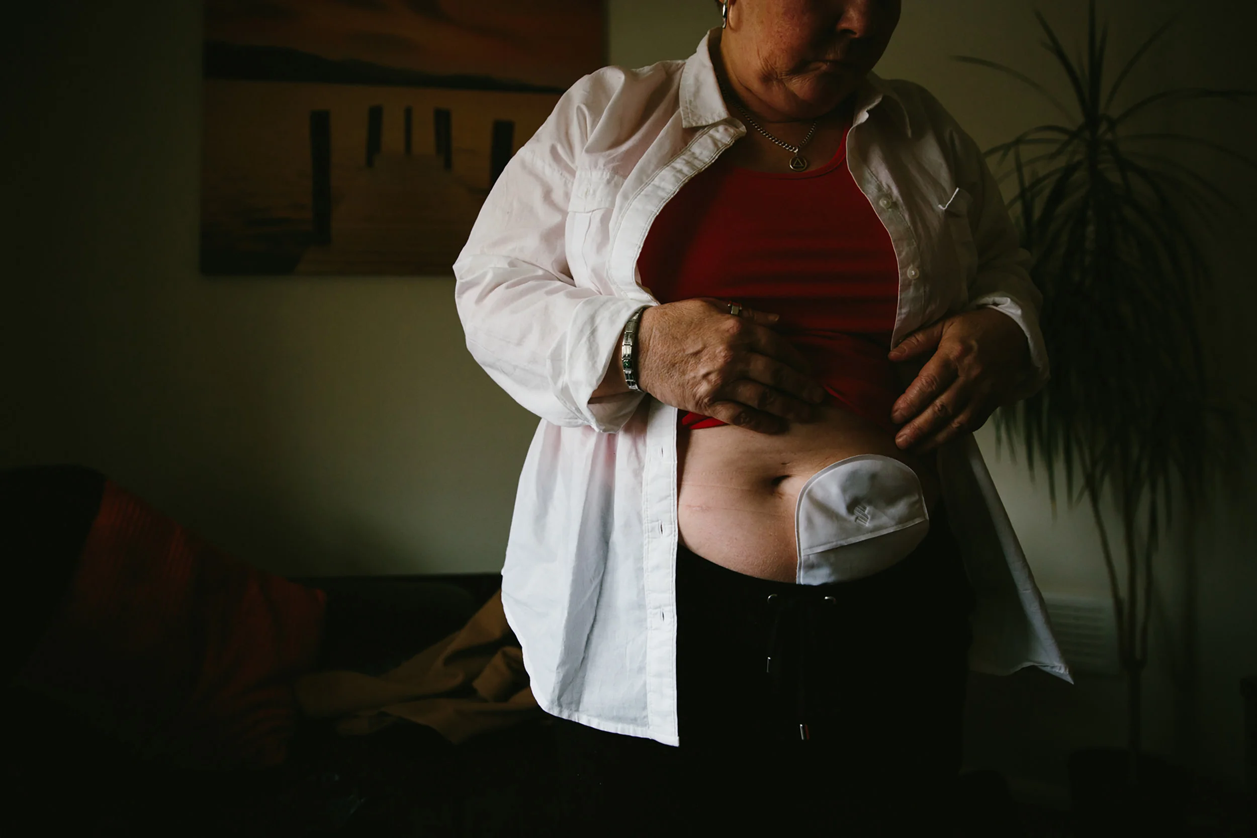 Gill’s mesh was eventually removed, but in doing so the surgeon was forced to remove Gill’s rectum and part of her intestine. She has been left with a permanent stoma and faces more surgery to close the incision wound, still open two years after the initial operation. It has to be packed and dressed three times each week
