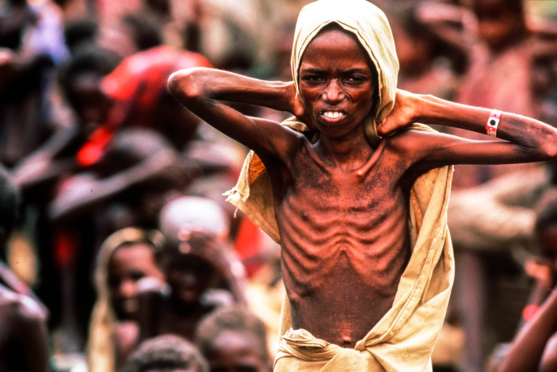 Bardera, Somalia - December 1992
An everyday scene in Somalia: the sight of a boy all skin and bones doesn't shock anyone.