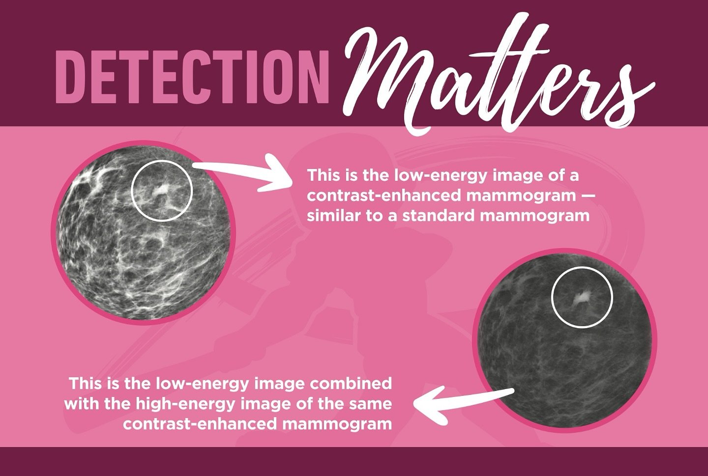 For the past three years, the Karen Friedman Baseball Camp for a Cure has supported the work
of Dr. Ramapriya Ganti and the Contrast Mammography Imaging Screening Trial, or CMIST. The
purpose of the CMIST study is to compare two methods of mammograph