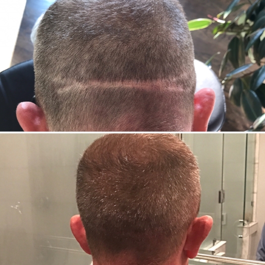 scalp micropigmentation | scar camouflage | hair transplant scar