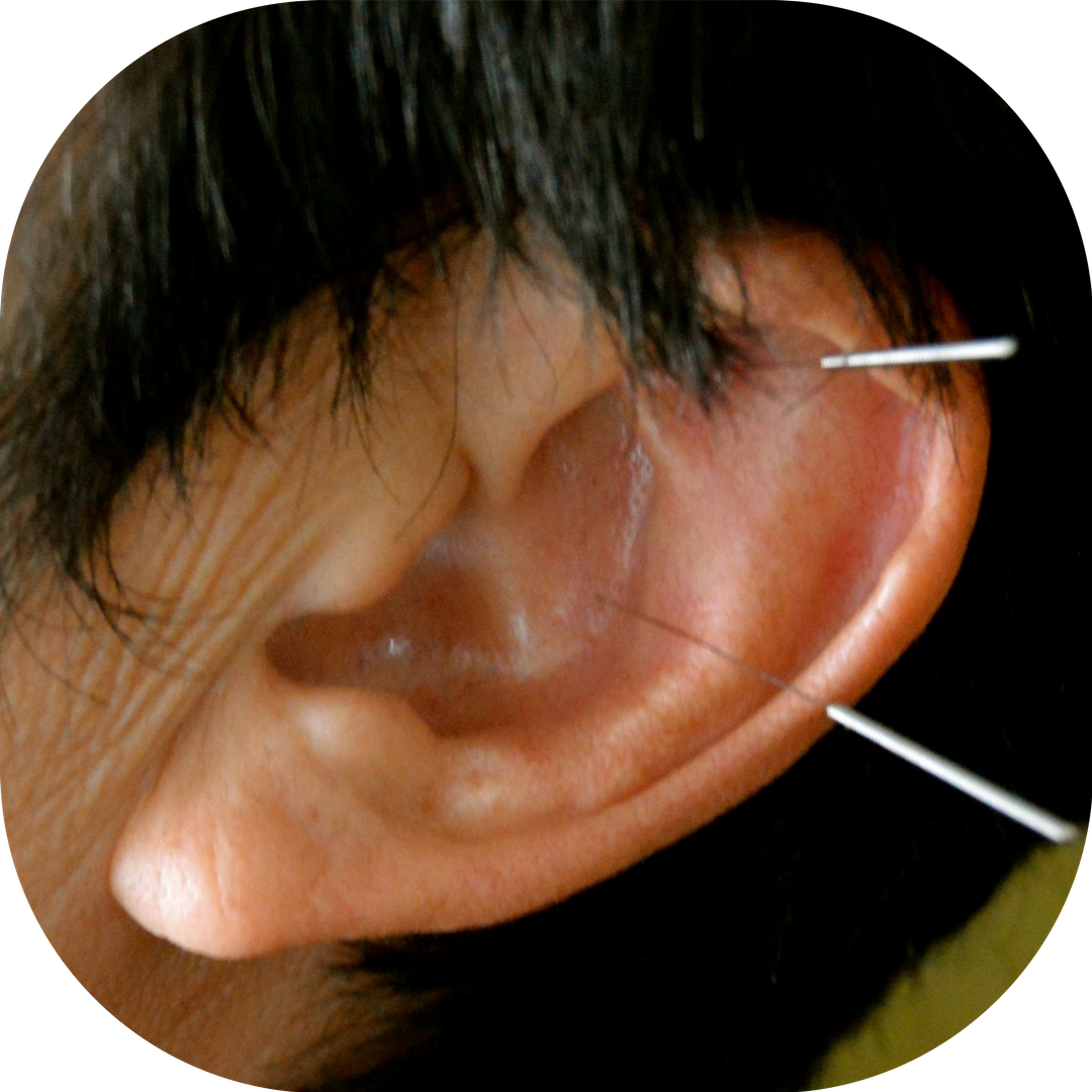 acupuncture needles in ear