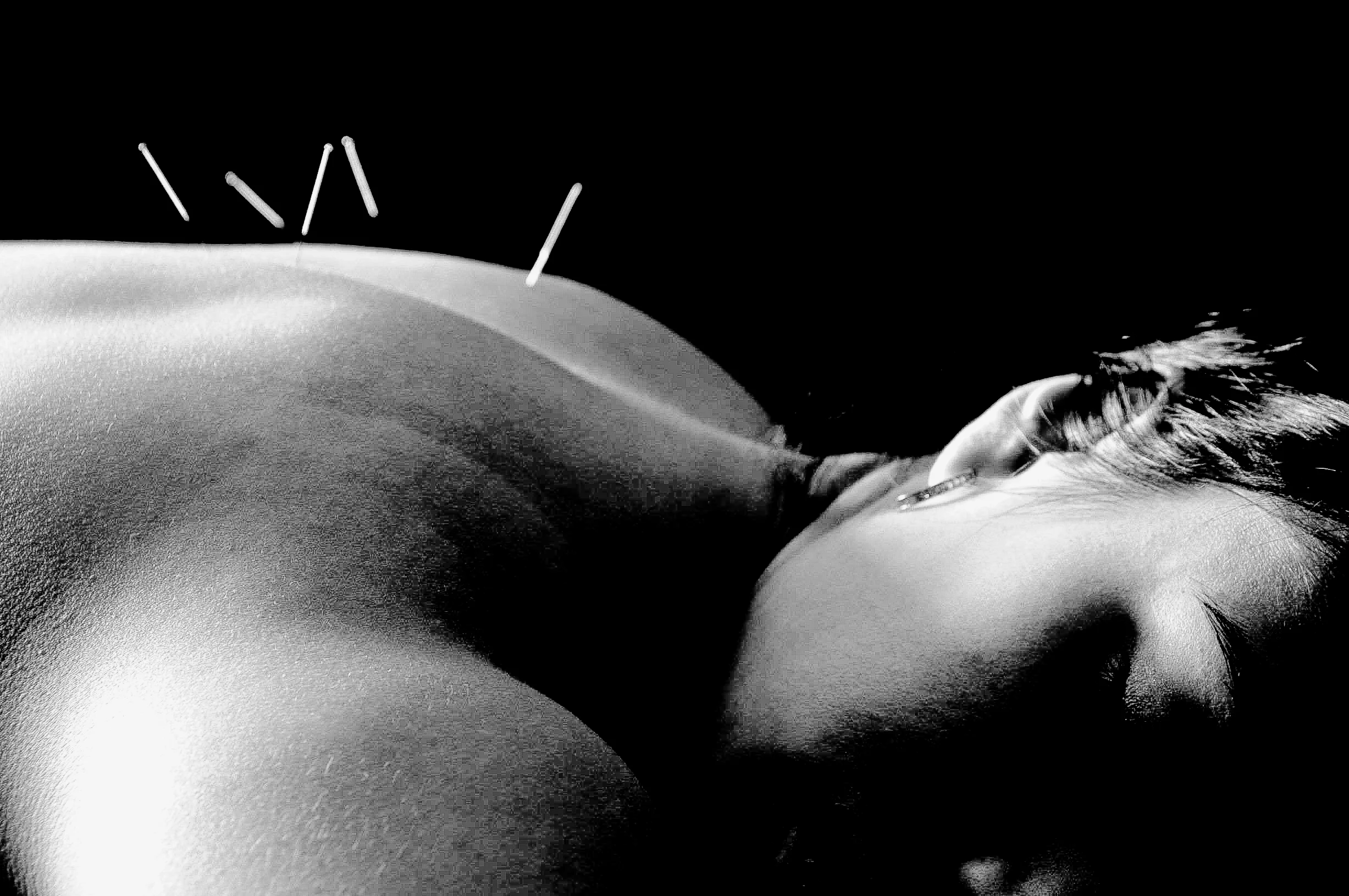 acupuncture 1 bw.jpg