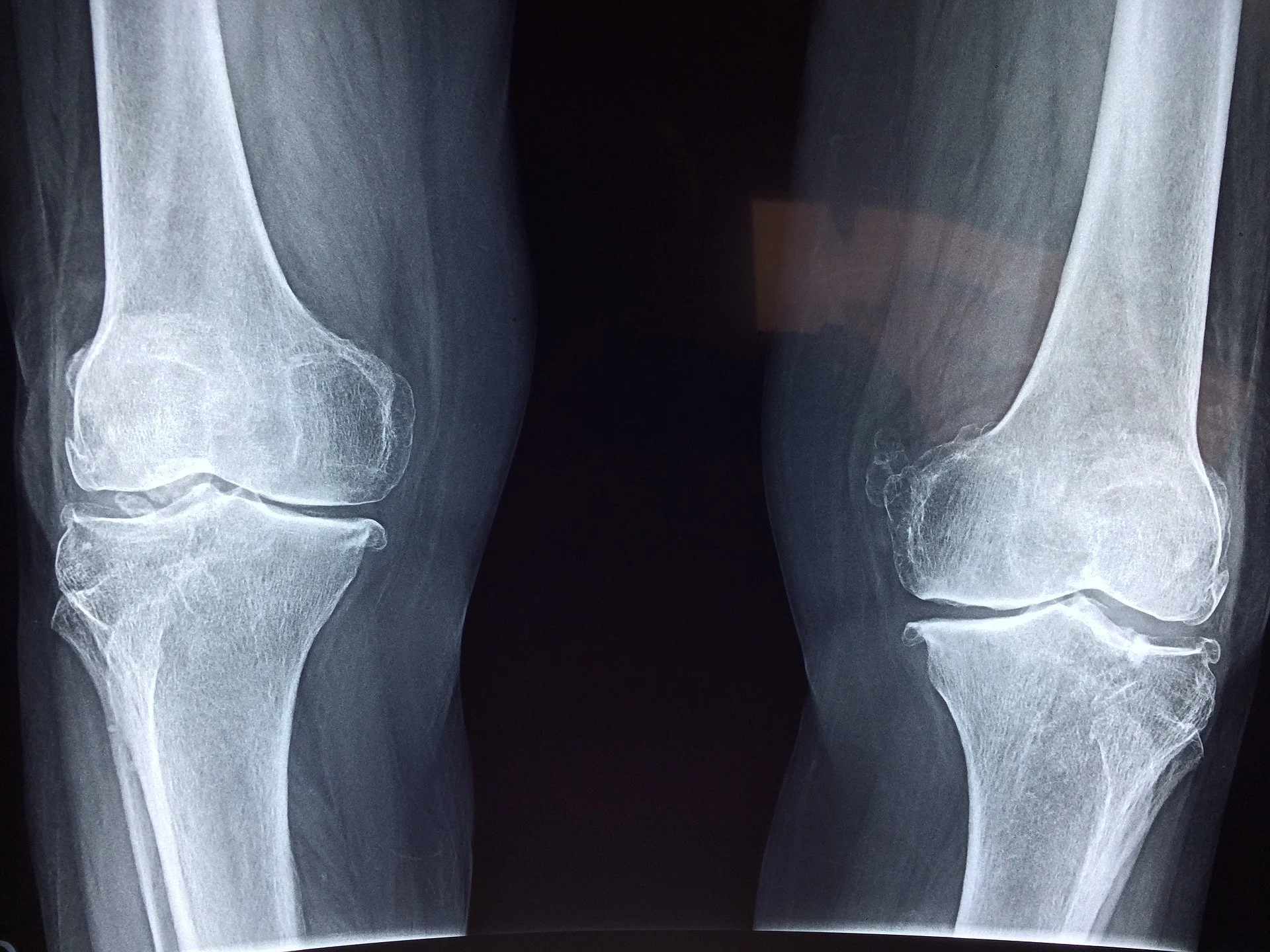 What are the most effective treatments for osteoarthritis?