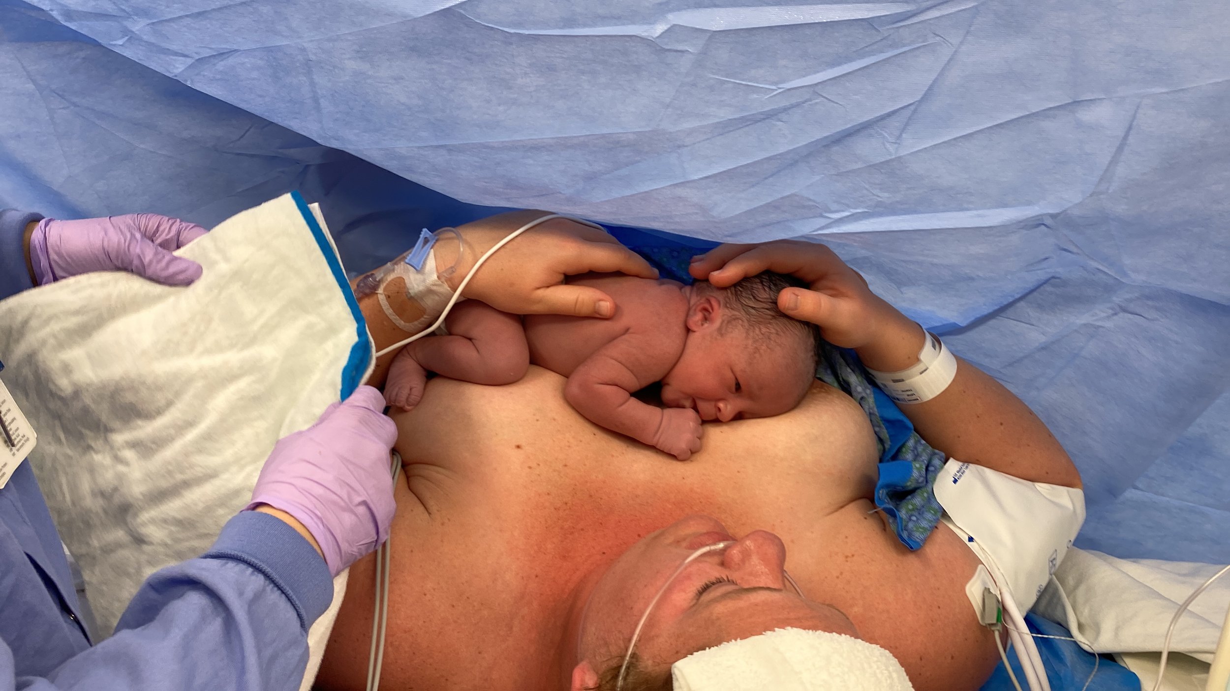 Skin to Skin After a Cesarean