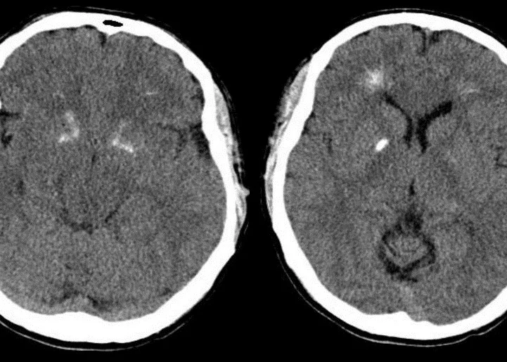 Consciousness Club #11 - "Determination of Death by Cessation of Brain Function"
