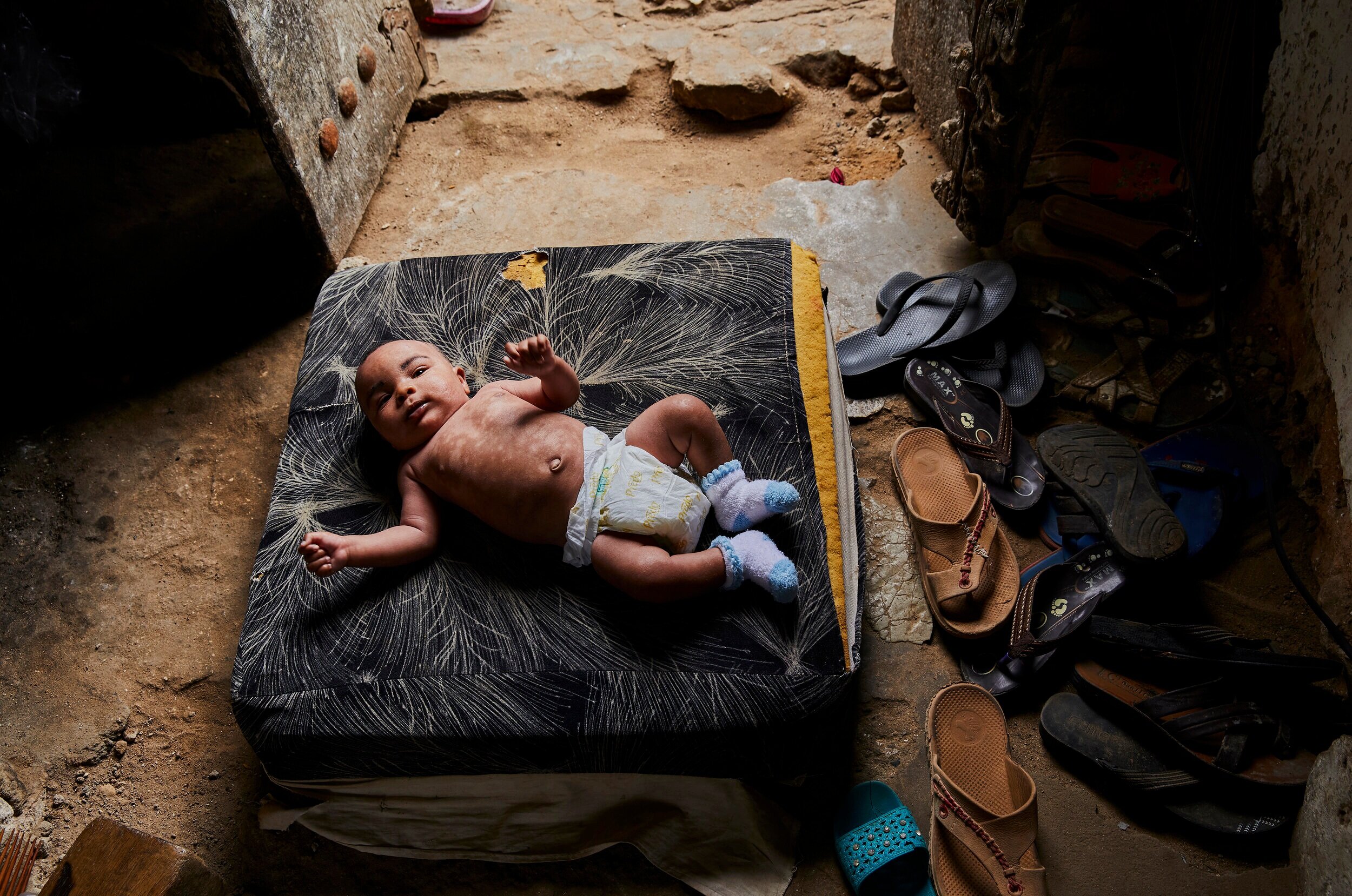  Infant, Ahee Bom, lays on a cushion in the hallway of his home where there is a slight breeze. Within weeks of his birth, the skin around his face and abdomen began to significantly darken and peel off in large strips. Mnazi Mmoja Hospital dermatolo