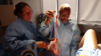 3rd stage of labor - placenta has been birthed.