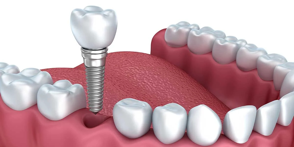 implant.jpg