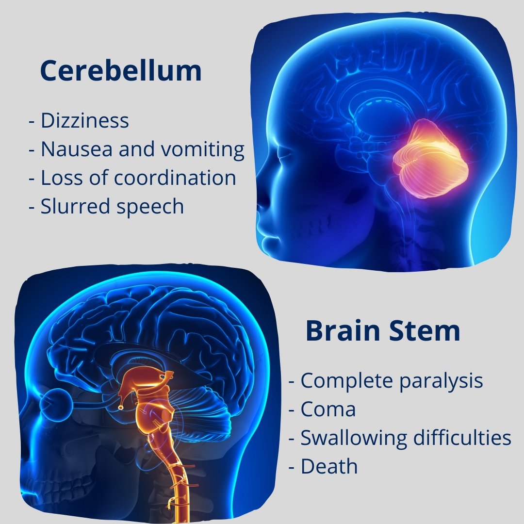 A Stroke of Genius Stroke Prevention and Management — Wellness