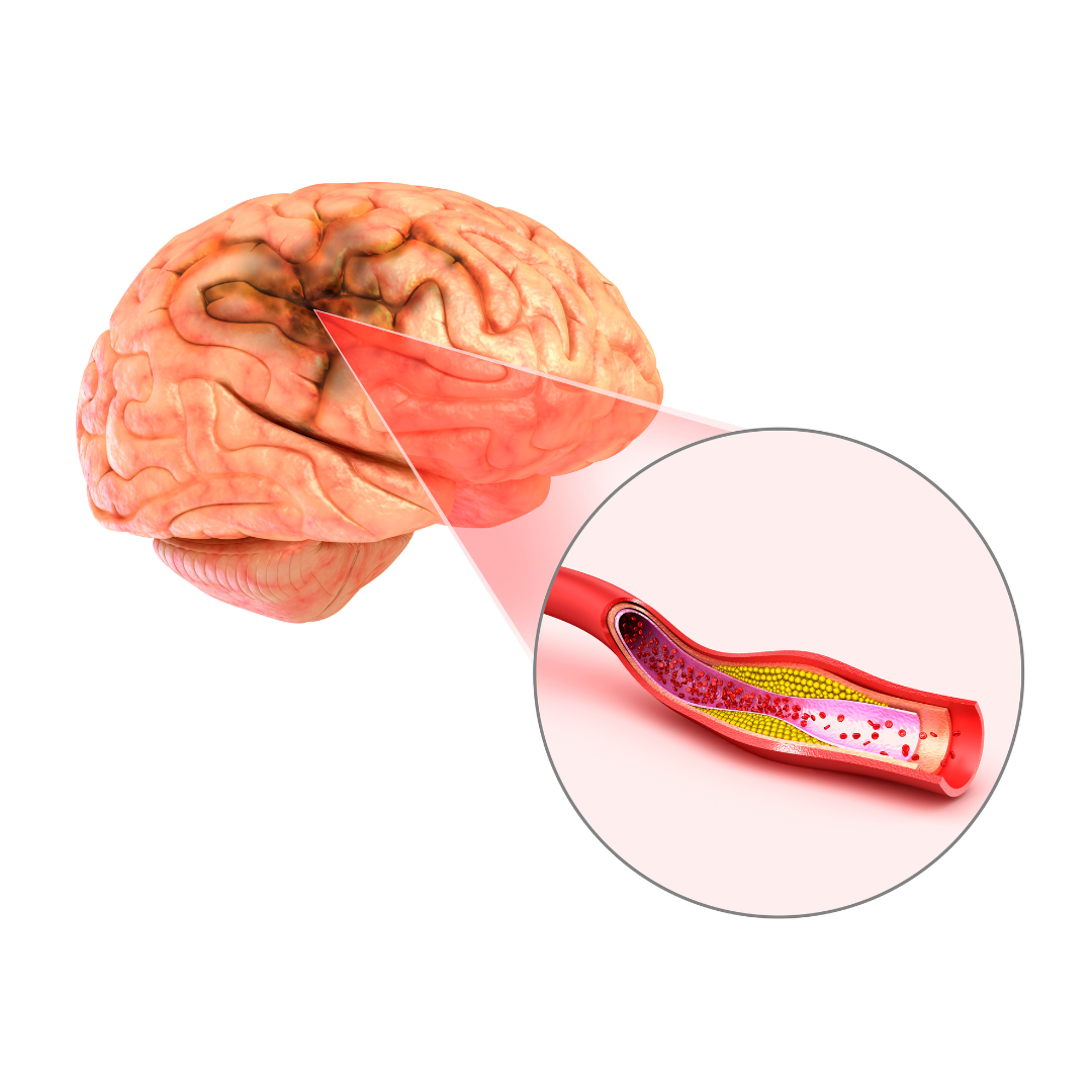 A Stroke of Genius Stroke Prevention and Management — Wellness