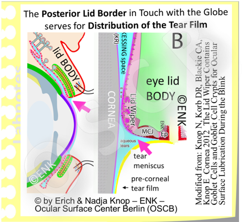 The inner lid border zones: The MucoCutaneous Junction (MCJ) is the transformation zone from the dry skin-epidermis to the aqueous-wet mucosa NS faces the palpebral fissure. The lid wiper for tear distribution is opposed to in in touch with the globe.