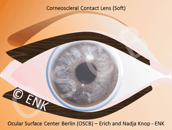 OVERVIEW of Contact Lenses — Ocular Surface Center Berlin