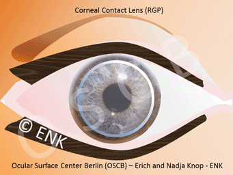 Ontwapening voor de hand liggend native DEEPER INSIGHT into ... Contact Lenses - HISTORY - TYPES - SCHEDULES -  FITTING — Ocular Surface Center Berlin
