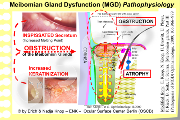 Meibomian Gland Dsfunction (MGD) is the main reason for a deficiency of tear film lipids . In MGD there is a quantitative deficiency of lipids on the lid margin and tear film due to the gland obstruction. At the same time there is also a qualitative deficiency of lipids because hardened, opaque lipid species of increased melting point occur, as well as irritant free fatty acids with negative influence on the lid margin tissue and on the stability of the tear film.
