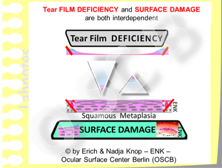 Tear Film and and Ocular Surface Damage are closely interrelated and interdependent - in the normal physiology as well as in pathology . An intact tear film can only bind bind to an intact epithelial surface and the mucosal surface only remains intact when it is permanently kept moist by the tear fluid. In the "typical" Dry Eye Disease that the clinician sees in everyday practice Tear Film Deficiency is typically first and induces Surface Damage - whereas a primary Surface Damage is relatively rare although it may occur in certain conditions.