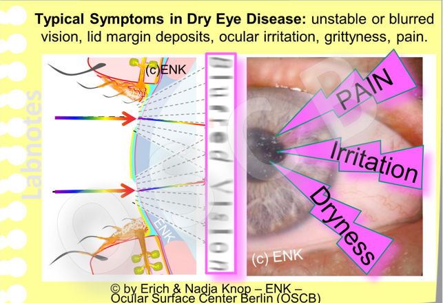 Some typical SYMPTOMS in DRY EYE DISEASE concern those that can easily be verified and quantified, such as alteration of visual acuity, ... and those that involve very subjective feelings such as dryness, irritation and pain.