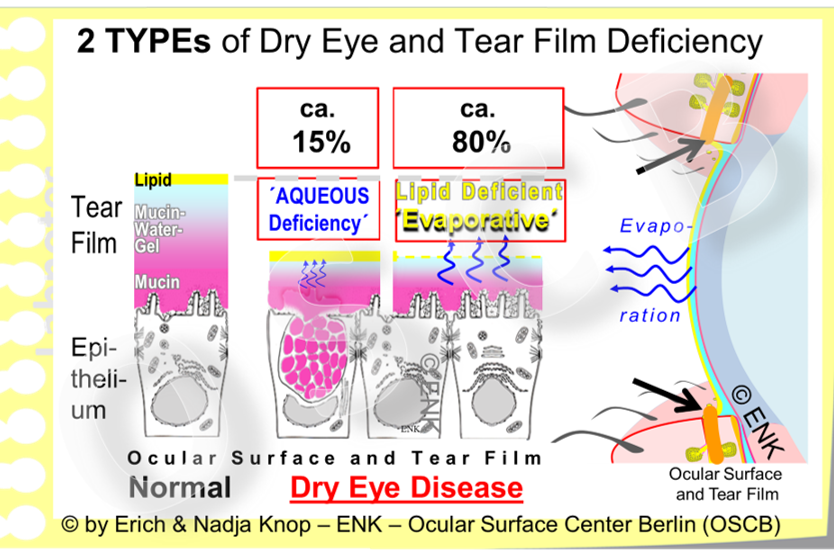 The most frequent types of Dry Eye Disease are due to a deficiency of the lipid phase and of the aqueous phase . Even though the term Dry Eye Disease seems to imply that a loss of water must be more important, the main reason, according to the present data, is a primary deficiency of tear film lipids ... which can then lead to a secondary loss of water by evaporation.