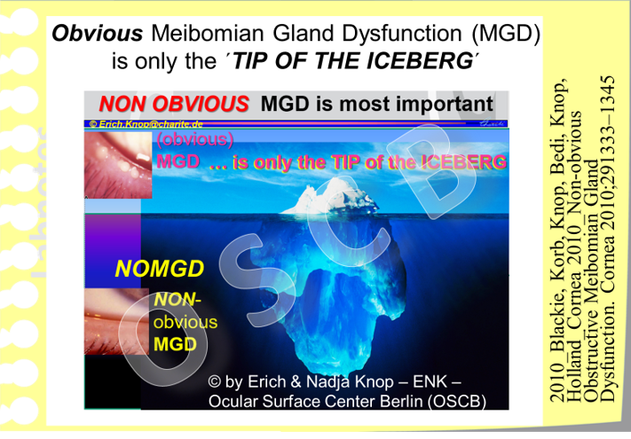 The initial type of MGD is a symptomatic - since it goes without symptoms. It is also clinically inconspicuous and is termed as Non-Obvious MGD (NOMGD) . A high proportion of elderly individuals conceivably has NOMGD which may already lead to an unnoticed destruction of the Meibomian glands inside the eye lids due to the increased pressure inside obstructed glands.