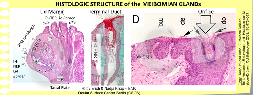 The terminal duct of the Meibomian glands is an ingrowth of the cornified surface epithelium. The wall of the Meibomian orifice (open arrow) therefore consists of fully cornified epidermis with luminal anuclear keratin squames. The shed epitheliallamellae are typically located inside the lumen of the orifice and can easily obstruct it when additional factors occur, such as Meibomian Lipids with increased melting point.