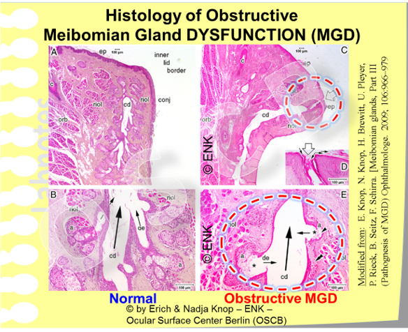 Histological Studies of the Ocular Surface Center Berlin (OSCB) have revealed some typical alterations of Meibomian Glands in MGD (right) compared to normal glands (left). This concerns an obstruction of the orifice by keratinized material (top right) and signs of gland atrophy (bottom right). This is explained in more detail for the higher resolution image below.