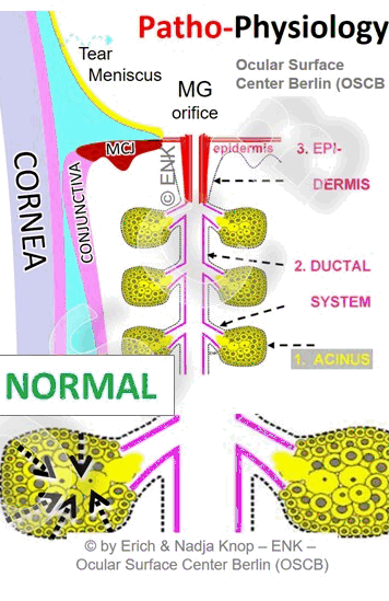 The Pathomechanism of Obstructive MGD is schematically shown in this ANIMATION. In the NORMAL state the OIL is first SECRETED in an acinus and then driven towards the orifice by the secretory pressure that results from continuing secretion. In OBSTRUCTION of the terminal duct and orifice, the secreted oil can not get out of the gland to be delivered onto the lid margin - which results in a lack of oil on the tear film. The continuing secretory pressure inside the gland leads to a dilatation of the ductal system and apparently the stasis of oil in the gland pre-disposes the secretum to become inspissated. Eventually the increased pressure enters the secretory acini and destroys the secretory cells (Meibocytes) .