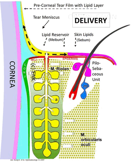 Meibom Incision Meibomian Gland Dysfunction (MGD) — Ocular Surface Center Berlin
