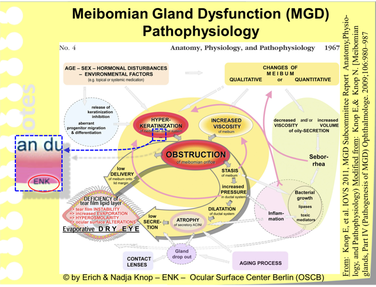 The Summary Figure of the TFOS MGD Workshop Report summarizes the main factors in the Pathophysiology of MGD - and thus explains, which pathogenetic factors contribute to the onset and worsening of MGD and how they interact in this process.