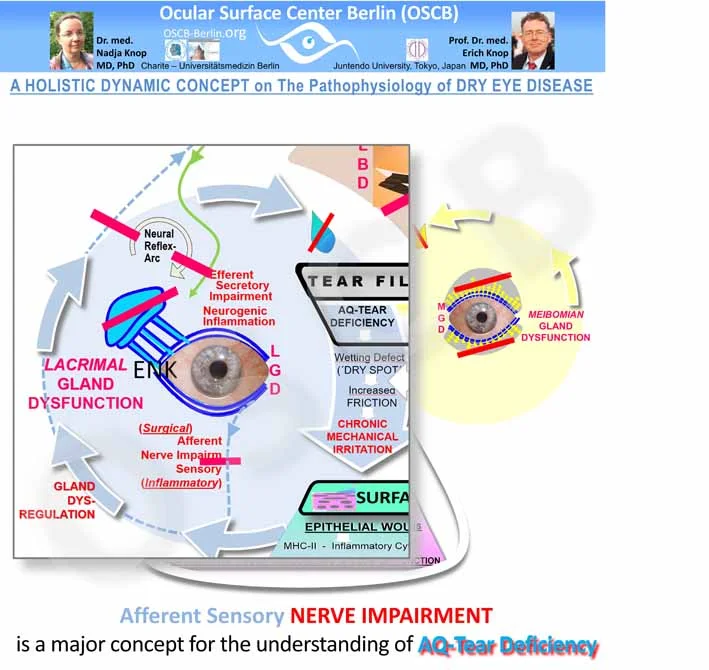 With increasing destruction of tissues and regulatory systems in moderate to severe Dry Eye Disease the primary types of tear film deficiency tend to mix because the ocular surface becomes increasingly dysregulated. A main concept for aqueous tear deficiency is based on such dysregulation that occurs when the afferent sensory innervation at the ocular surface proper, cornea and conjunctiva is impaired and thus the neural reflex arc for tear secretion is altered resulting in lower aqueous secretion. 