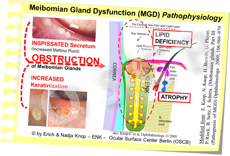 The main pathogenetic factors for obstructive Meibomian Gland Dysfunction are an inspissation of the lipid secretum due to increase melting point and a hyperkeratinization of the ductal system and lid margin.