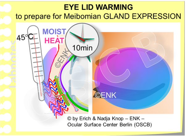 OSCB-Bild_2_Meibomian Gland_Meibomian Gland Dysfunction, MGD THERAPY_EYE LID WARMING.png