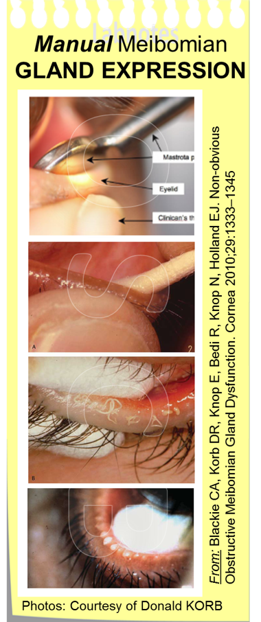 Meibomian Gland Dysfunction Expression Meibomian Gland Dysfunction Expression