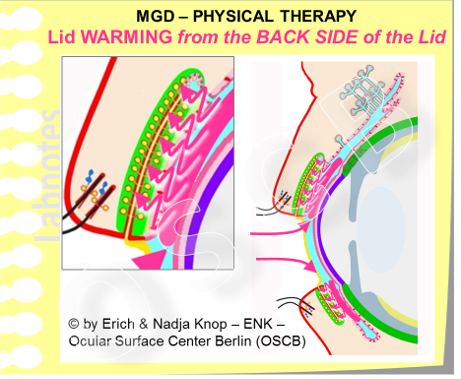 Deeper Insight THERAPY 4 MGD Therapy Ocular Surface Center Berlin deeper-insight-therapy-4-mgd-therapy-ocular-surface-center-berlin