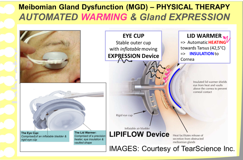 The most innovative and effective treatment for obstructive Meibomian Gland Dysfunction is presently an automated simultaneous lid warming and gland expression procedure . This is achieved by the LIPIFLOW device that was built according to the ideas of Prof. Donald Korb from Boston, MA, who is a one of the most experienced clinician for Meibomian Gland Dysfunction. (Images: Courtesy of TearScience Inc.)