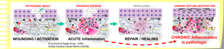 OSCB-Bild_6_Dry Eye Disease_INFLAMMATION, Pathophysiology_Pathways of Ocular Surface INFLAMMATION_SIMPLE_QUER.png