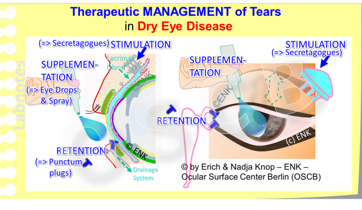 ... two sides of the same coin show that the MANAGEMENT OF TEARS and their deficiency, respectively, at the Ocular Surface can dissected into different steps which are: (1) The STIMULATION of natural tear flow by secretagogues, (2) the SUPPLEMENTATION of tear components either as individual components such as e.g. just lipids, or as a kind of complete solution as " Artificial Tears ", and (3) the RETENTION time of the tear fluid at the Bulbar Surface before they disappear and drain into the lacrimal drainage system ... which also is a p art of the Ocular Surfac e but can no longer k eep the cornea and conjunctiva mois t.
