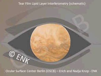 Another feature of a TFLL in interferometry is that the lipid layer tends to fold in a plicated fashion in the down-stroke of a blink ... and unfolds again in much the same shape during the up-stroke.