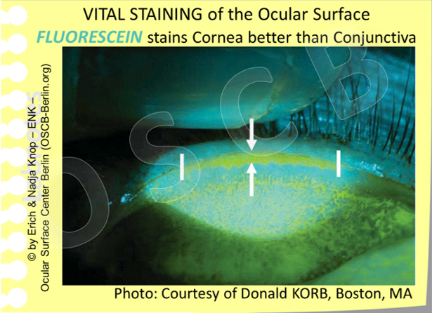 FLUORESCEIN Vital Staining of the L id Wiper Epitheliu m of the marginal Conjunctiva. The staining is intensely bluish-green. Fluorescein stains the pathological Lid Wiper Epitheliopathy (LWE) but it is also lying on the tarsal conjunctiva in the middle of the image and partly demarcates substructures such as crypts and other surface irregularities. This superimposition of fluorescein on the epithelium is not a real staining because, as seen in the next image with Lissamine Green staining, the tarsal conjunctiva in such patients is typically unaltered and healthy.