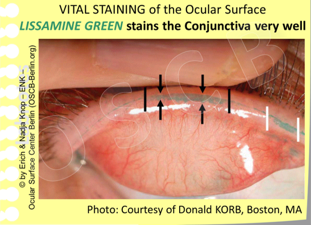 Deeper Insight Diagnosis 4 Surface Tissue Damage Ocular Surface Center Berlin