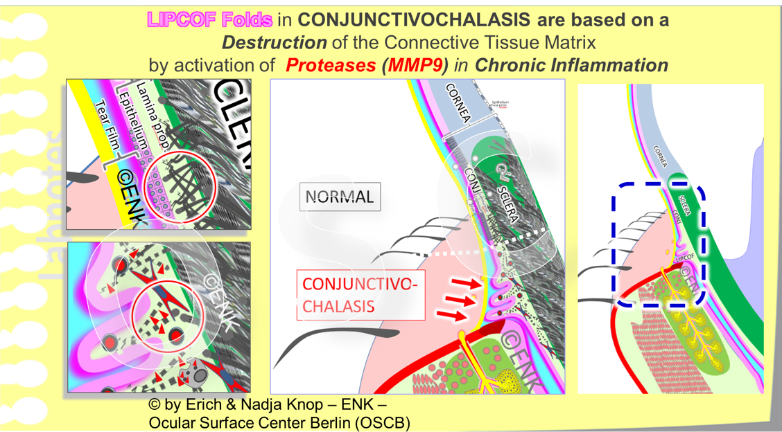 Lid-Parallel Conjunctival Folds (LIPCOF) occur when the structural collagen meshwork of the conjunctival connective tissue (Lamina propria) is degraded by proteinases, mainly Matrix-Metalloproteinase 9 (MMP9). The loosening of the conjunctiva is termed ´conjunctivochalasis´. MMP9 is increasingly activated during the chronic inflammatory process in Dry Eye Disease. The loose conjunctiva is then ´shoveled up´ by the relatively sharp posterior lid border and folds up onto the posterior lid border. For simplicity, a zone with ´NORMAL´ collagen structure is shown here directly besides the ´CONJUNCTIVOCHALASIS´. It must however be assumed that the whole conjunctiva is relatively homogeneously affected by this destruction in Chronic Dry Eye Disease.