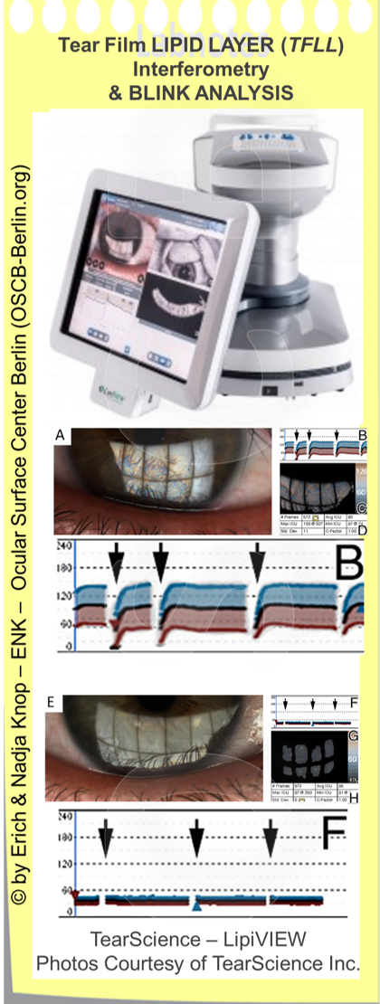 Analysis of the BLINK PATTERN is an important feature of Ocular Surface and Tear Film investigation- but this is typically not supported by available devices. Blinking is of utmost importance for the correct formation of the pre-ocular tear Film and its lipid layer (TFLL) because even a sufficient amount and delivery of lipids from the Meibomian Gland does still not render an intact and stable tear film when the blink pattern is disturbed and e.g. partial blinks occur. Partial blinks are difficult to record manually in particular when the patient is aware of this. Much easier and more reliable is an automatic recording of the blink pattern together with investigations suh as lipid layer thickness, as seen here with the Lipiview, or of N on- I nvasive B reak- U p T ime ( NI-BUT ).