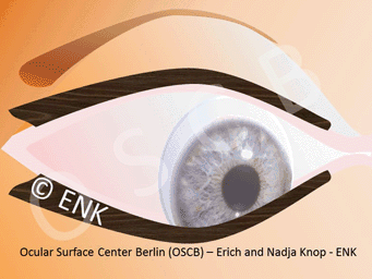 Contact lens wear is a general stress factor for the Ocular Surface and Tear Film. CL e.g. increase the frictional forces during the normal eye movements and blinking. Therefore CL wear has higher requirements for tear volume and (lubricative) quality than required in non-CL-wearers.