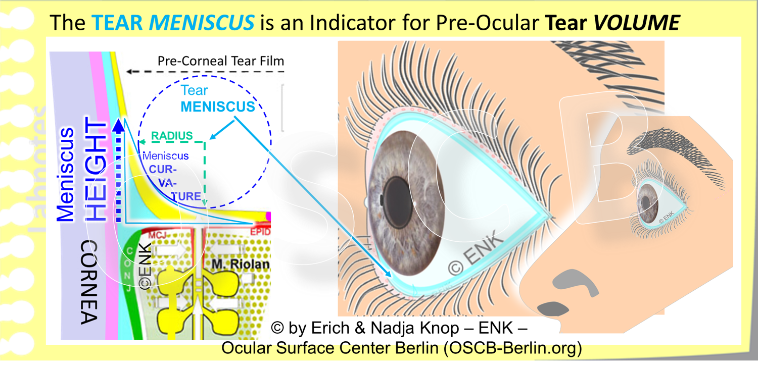 The pre-ocular Tears are lined at the upper and lower Lid Margins by a fluid rim that contains more tears and is termed the TEAR MENISCUS . It sits on the posterior lid border and its bottom is the Line of Marx , that, in turn, represents the surface of the m uco-cutaneous junction ( MCJ ) - a specialized epithelial transition zone that transforms the aqueous-wettable mucosa of the conjunctiva into the oily-dry skin. In cross-section (left image), the tear meniscus has a roughly triangular shape where the back side is constituted by the cornea , or the conjunctiva, and the frontal anterior side forms a parabolic curve . The filling and thus volume of the tear meniscus corresponds to the volume of the pre-ocular tears. Analysis of the meniscus thus provides surrogate parameters for the tear volume. With increasing tear volume the apparent height, i.e. the apparent upper end of the tear meniscus, in creases and the curvature, i.e. the radius of the circle that best approximates the parabolic anterior surface of the tear meniscus, becomes larger (please see the diagram). With de creasing tear volume the opposite changes occur. Decreased tear volume typically causes increased m echanical frictio n . When the decreasing tear meniscus is due to increased evaporation, which is the most frequent case this also leads to tear h yper-osmolarit y (The relative thickness of the tear film and of its lipid layer are exaggerated in the drawing, relative to the tissue of the lid margin).