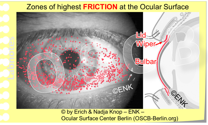 d-Diagnose-4 GEWEBESCHÄDEN — Ocular Surface Center Berlin