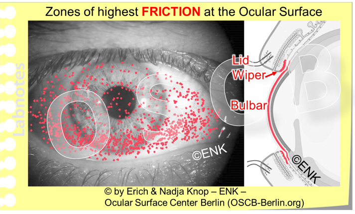 Friction occurs mainly at the bulbar surface inside the palpebral fissure and at the palpebral posterior lid border, mainly in the upper eye lid but also to a certain extent in the lower lid. Under normal conditions there is enough lubrication available by a sufficient amount of tear fluid and additional lubricative proteins such as lubricin . In conditions of increased friction, such as in Dry Eye Disease and Contact lens wear the normal movements of eye ball and lids against each other already cause epithelial damage. This can be made visible by ´Vital Staining´using different stains because the wounded cells pick up the stain and the normal ones don´t. The staining at the eye ball is termed as corneal or conjunctival staining or superficial punctate keratitis or just as ´Vital staining´. The vital staining of the elevated epithelial lip of the lid wiper zone at the posterior lid border is termed Lid Wiper Epitheliopathy (LWE) by KORB and colleagues .