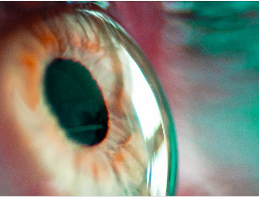 CORNEA & EyeBall