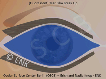 Die animierte schematische Zeichnung, zeigt einen sehr instabilem Tränenfilm. Hier bleibt er nach einem Lidschlag nur für etwa eine einzige Sekunde stabil ehe er aufbricht. Dies weist auf eine starke Störung des Systems hin und lässt nachfolgende Gewebeschädigung vermuten.