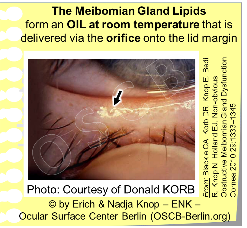 Healthy Meibomian Glands deliver a clear liquid oil (arrow) through their orifice onto the lid margin. This can be tested by a technique termed ´Diagnostic Expression´ with very mild pressure from the outside - every orifice should then deliver a little puddle of oil (arrow).