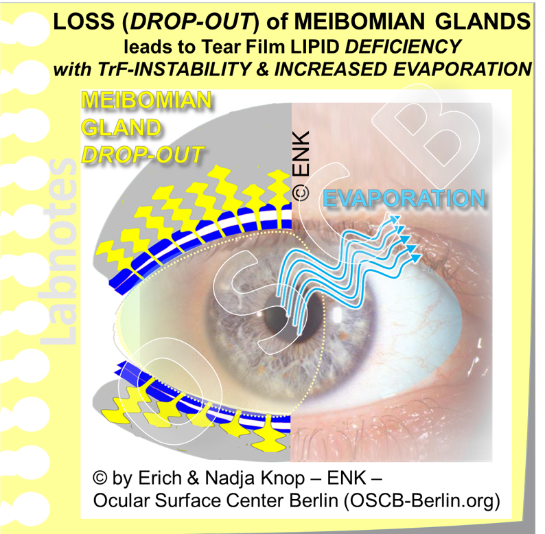 OSCB-Berlin.org_LOSS (DROP-OUT) of MEIBOMIAN GLANDS leads to Tear Film LIPID DEFICIENCY with TrF-INSTABILITY and INCREASED EVAPORATION_TrF HELLER.png